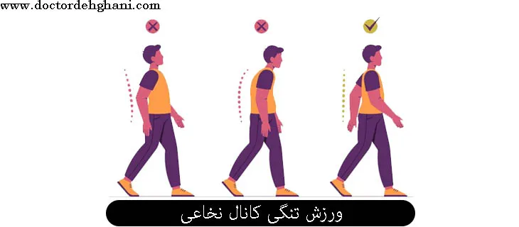 ورزش تنگی کانال نخاعی