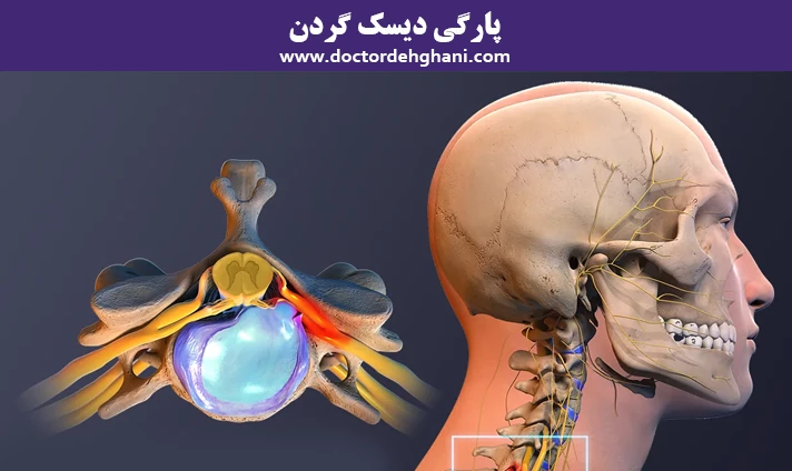 پارگی دیسک گردن