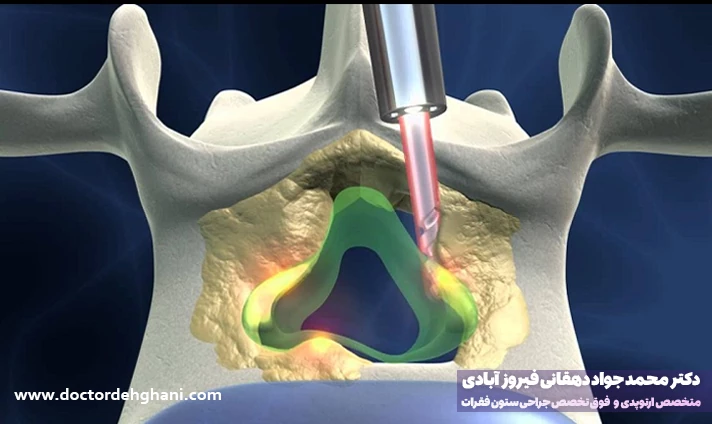 عوامل تاثیرگذار بر هزینه جراحی دیسک گردن با لیزر