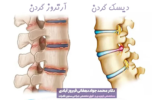 فرق آرتروز گردن و دیسک گردن
