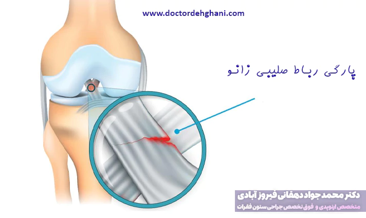 علائم پارگی رباط صلیبی زانو