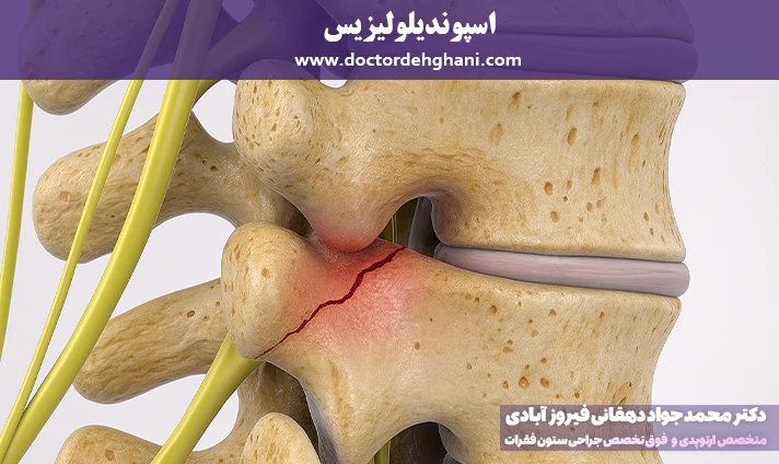 اسپوندیلولیزیس