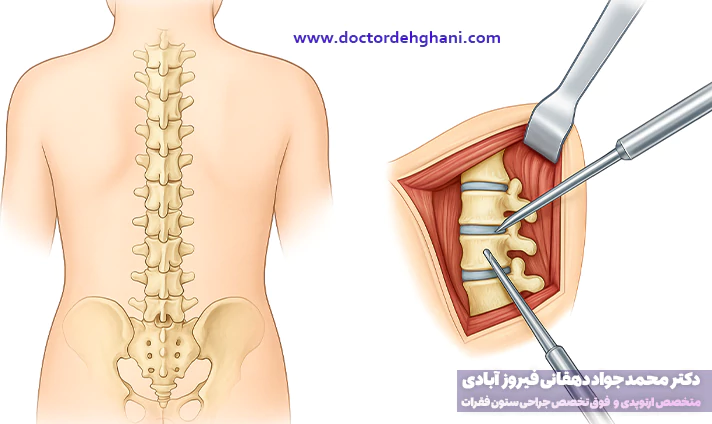 مزایای جراحی ستون فقرات
